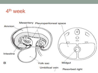 omphalocele and gastroschisis | PPTX