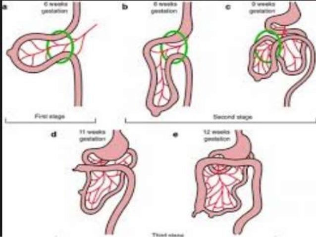omphalocele and gastroschisis