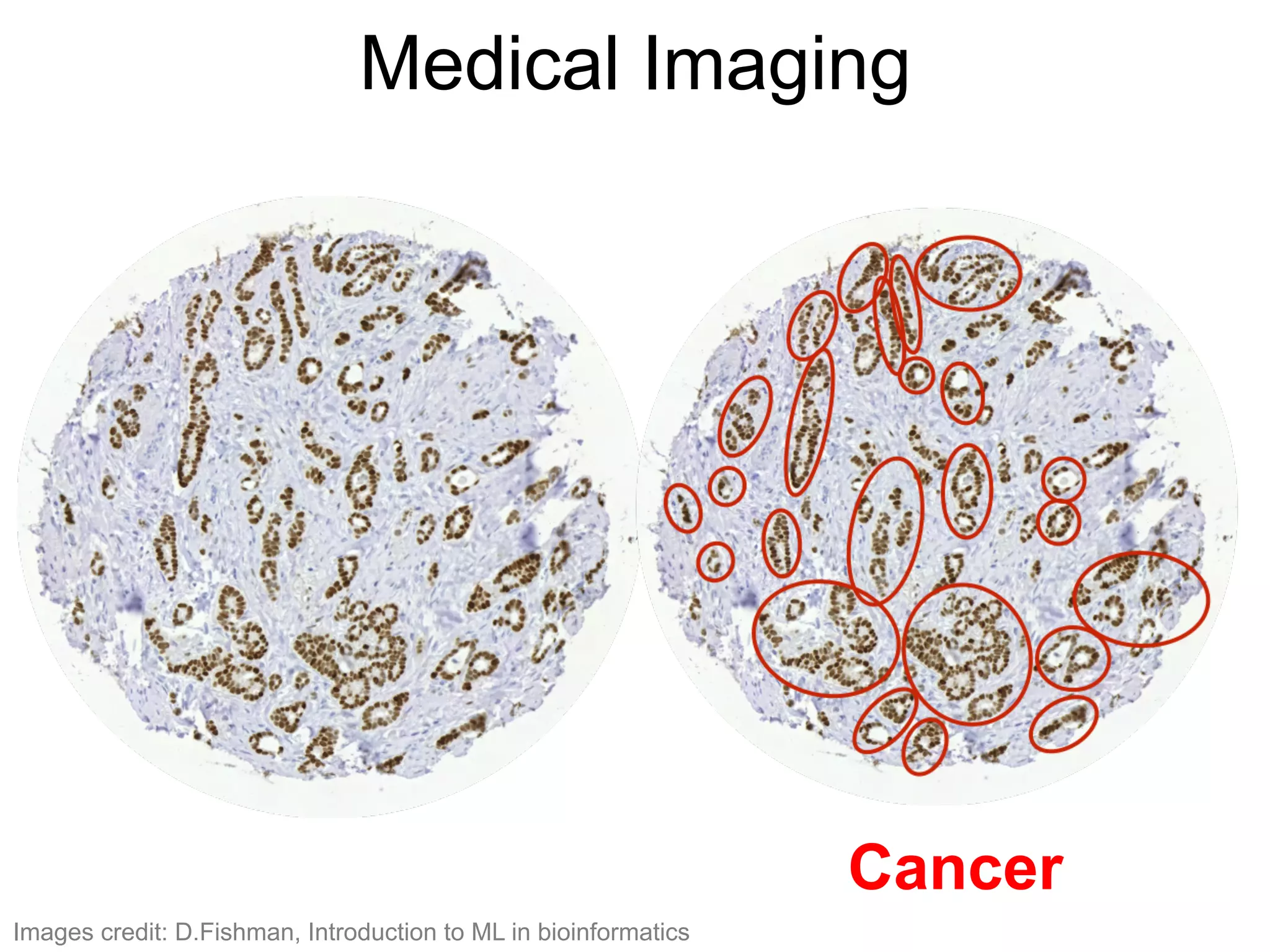 Medical Imaging
Cancer
Images credit: D.Fishman, Introduction to ML in bioinformatics
 