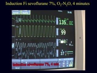 Induction Fi sevoflurane 7%, O2-N2O, 4 minutes
 