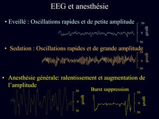 EEG et anesthésie
• Anesthésie générale: ralentissement et augmentation de
l’amplitude
50
50
mvolt
0
Burst suppression 50
50
mvolt
0
• Sedation : Oscillations rapides et de grande amplitude
50
50
mvolt
0
50
50
mvolt
0
• Eveillé : Oscillations rapides et de petite amplitude
 
