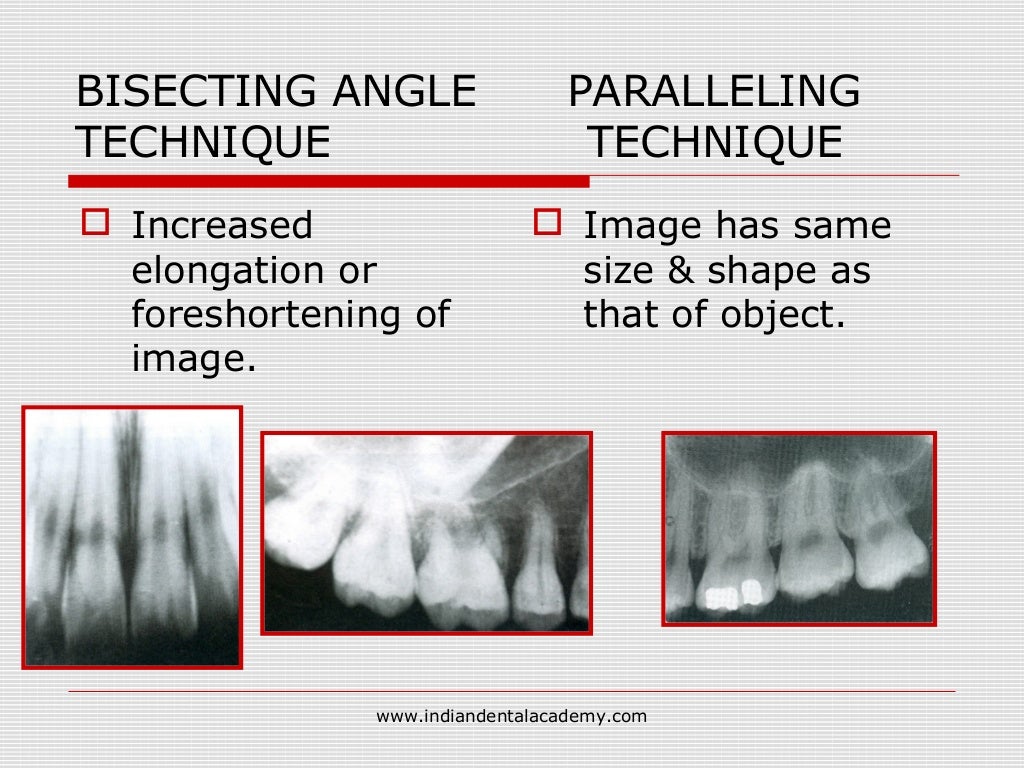 Bisecting angle vs paralleling technique /orthodontic courses by Indi…