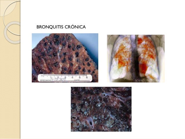 Bisinosis