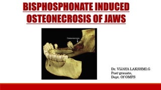 Bisphosphonate Associated Osteonecrosis Of The Jaw