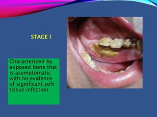 STAGE 1
Characterized by
exposed bone that
is asymptomatic
with no evidence
of significant soft
tissue infection
 