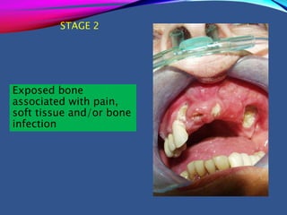 STAGE 2
Exposed bone
associated with pain,
soft tissue and/or bone
infection
 