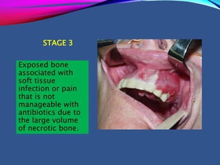 STAGE 3
Exposed bone
associated with
soft tissue
infection or pain
that is not
manageable with
antibiotics due to
the large volume
of necrotic bone.
 