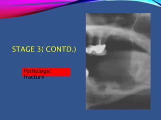 STAGE 3( CONTD.)
Pathologic
fracture
 