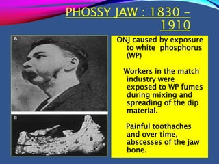PHOSSY JAW : 1830 -
1910
ONJ caused by exposure
to white phosphorus
(WP)
Workers in the match
industry were
exposed to WP fumes
during mixing and
spreading of the dip
material.
Painful toothaches
and over time,
abscesses of the jaw
bone.
 