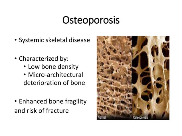 Bisphosphonates in Osteoporosis.pptx | Bone and Joint Conditions ...