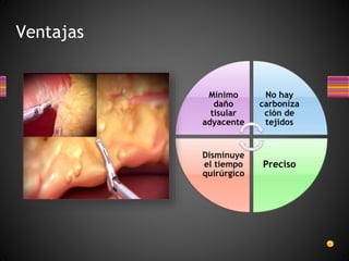 Ventajas
Mínimo
daño
tisular
adyacente
No hay
carboniza
ción de
tejidos
Preciso
Disminuye
el tiempo
quirúrgico
 