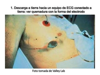Foto tomada de Valley Lab
1. Descarga a tierra hacia un equipo de ECG conectado a
tierra: ver quemadura con la forma del electrodo
 