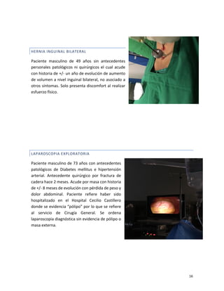 16
HERNIA INGUINAL BILATERAL
Paciente masculino de 49 años sin antecedentes
personales patológicos ni quirúrgicos el cual acude
con historia de +/- un año de evolución de aumento
de volumen a nivel inguinal bilateral, no asociado a
otros síntomas. Solo presenta discomfort al realizar
esfuerzo físico.
LAPAROSCOPIA EXPLORATORIA
Paciente masculino de 73 años con antecedentes
patológicos de Diabetes mellitus e hipertensión
arterial. Antecedente quirúrgico por fractura de
cadera hace 2 meses. Acude por masa con historia
de +/- 8 meses de evolución con pérdida de peso y
dolor abdominal. Paciente refiere haber sido
hospitalizado en el Hospital Cecilio Castillero
donde se evidencia “pólipo” por lo que se refiere
al servicio de Cirugía General. Se ordena
laparoscopia diagnóstica sin evidencia de pólipo o
masa externa.
 