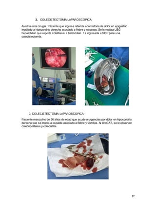 17
2. COLECISTECTOMIA LAPAROSCOPICA
Asistí a esta cirugía. Paciente que ingresa referida con historia de dolor en epigastrio
irradiado a hipocondrio derecho asociado a fiebre y nauseas. Se le realiza USG
hepatobiliar que reporta colelitiasis + barro biliar. Es ingresada a SOP para una
colecistectomía.
3. COLECISTECTOMIA LAPAROSCOPICA
Paciente masculino de 56 años de edad que acude a urgencias por dolor en hipocondrio
derecho que se irradia a espalda asociado a fiebre y vómitos. Al UroCAT, se le observan
coledocolitiasis y colecistitis.
 