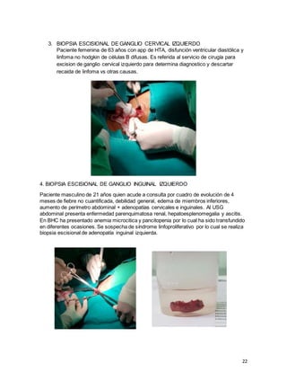22
3. BIOPSIA ESCISIONAL DE GANGLIO CERVICAL IZQUIERDO
Paciente femenina de 63 años con app de HTA, disfunción ventricular diastólica y
linfoma no hodgkin de células B difusas. Es referida al servicio de cirugía para
excision de ganglio cervical izquierdo para determina diagnostico y descartar
recaida de linfoma vs otras causas.
4. BIOPSIA ESCISIONAL DE GANGLIO INGUINAL IZQUIERDO
Paciente masculino de 21 años quien acude a consulta por cuadro de evolución de 4
meses de fiebre no cuantificada, debilidad general, edema de miembros inferiores,
aumento de perímetro abdominal + adenopatías cervicales e inguinales. Al USG
abdominal presenta enfermedad parenquimatosa renal, hepatoesplenomegalia y ascitis.
En BHC ha presentado anemia microcitica y pancitopenia por lo cual ha sido transfundido
en diferentes ocasiones. Se sospecha de síndrome linfoproliferativo por lo cual se realiza
biopsia escisional de adenopatía inguinal izquierda.
 