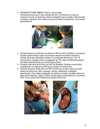 24
2. APENDICECTOMIA ABIERTA (Asistí a esta cirugía)
Paciente femenina de 27 años referida del HILT con historia de 2 dias de
evolución de dolor de aparición súbita en epigastrio que se irradia a FID asociado
a vómitos y náuseas. Se le realiza urocat y se evidencia apendicitis. Se le realiza
apendicetomía
3. Paciente femenina de 58 años de edad con APP de HTA y DM tipo 2 con historia
de dolor abdominal tipo cólico en fosa iliaca derecha asociada a náuseas y
vómitos #3 de tipo alimentario y fiebre no cuantificada desde hace 1 día. Al
examen físico, presenta dolor a la palpación en FID, signo de Bolmberg positivo.
Se realiza apendicetomía por incisión Rocky Davis.
4. Paciente masculino de 65 años con APP de Diabetes. Paciente se encuentra
hospitalizado y lo ingresan a SOP para sanarle una ulcera sacra.
5. Paciente femenina de 66 años con APP de HTA que acude a clínica por dolor
abdominal difuso tipo cólico, náuseas, vómitos, hipotensión y debilidad
generalizada. Se le realiza radiografía de abdomen simple y se refleja signos de
obstrucción intestinal. Llega al CSS en shock séptico e hipovolémico, se admite a
SOP y se le realiza hemicolectomia e ileostomía terminal.
 