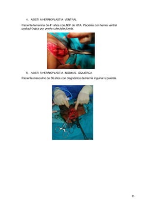 31
4. ASISTI A HERNIOPLASTIA VENTRAL
Paciente femenina de 41 años con APP de HTA. Paciente con hernia ventral
postquirúrgica por previa colecistectomía.
5. ASISTI A HERNIOPLASTIA INGUINAL IZQUIERDA
Paciente masculino de 66 años con diagnóstico de hernia inguinal izquierda.
 