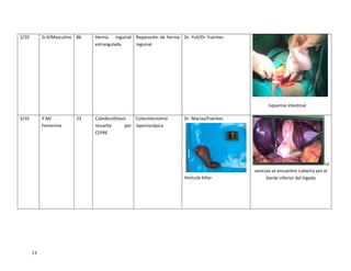 13
1/10 G.H/Masculino 86 Hernia inguinal
estrangulada
Reparación de hernia
inguinal
Dr. Yuil/Dr. Fuentes
Isquemia intestinal
3/10 Y.M/
Femenina
23 Coledocolitiasis
resuelta por
CEPRE
Colecistectomía
laparoscópica
Dr. Macias/Fuentes
Vesícula biliar
La
vesícula se encuentre cubierta por el
borde inferior del hígado
 