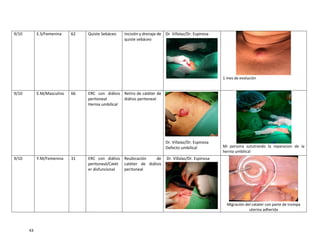 43
9/10 E.S/Femenina 62 Quiste Sebáceo Incisión y drenaje de
quiste sebáceo
Dr. Villalaz/Dr. Espinosa
1 mes de evolución
9/10 E.M/Masculino 66 ERC con diálisis
peritoneal
Hernia umbilical
Retiro de catéter de
diálisis peritoneal
Dr. Villalaz/Dr. Espinosa
Defecto umbilical Mi persona sututrando la reparacion de la
hernia umbilical
9/10 Y.M/Femenina 31 ERC con diálisis
peritoneal/Catét
er disfuncional
Reubicación de
catéter de diálisis
peritoneal
Dr. Villalaz/Dr. Espinosa
Migración del catater con parte de trompa
uterina adherida
 