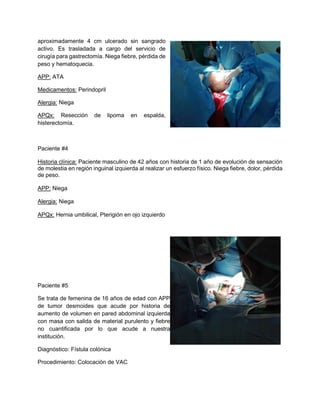 aproximadamente 4 cm ulcerado sin sangrado
activo. Es trasladada a cargo del servicio de
cirugía para gastrectomía. Niega fiebre, pérdida de
peso y hematoquecia.
APP: ATA
Medicamentos: Perindopril
Alergia: Niega
APQx: Resección de lipoma en espalda,
histerectomía.
Paciente #4
Historia clínica: Paciente masculino de 42 años con historia de 1 año de evolución de sensación
de molestia en región inguinal izquierda al realizar un esfuerzo físico. Niega fiebre, dolor, pérdida
de peso.
APP: Niega
Alergia: Niega
APQx: Hernia umbilical, Pterigión en ojo izquierdo
Paciente #5
Se trata de femenina de 16 años de edad con APP
de tumor desmoides que acude por historia de
aumento de volumen en pared abdominal izquierda
con masa con salida de material purulento y fiebre
no cuantificada por lo que acude a nuestra
institución.
Diagnóstico: Fístula colónica
Procedimiento: Colocación de VAC
 