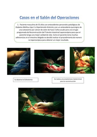 1. Paciente masculino de 55 años con antecedentes personales patológicos de
Diabetes Mellitus tipo 2 e Hipertensión Arterial y con un antecedente quirúrgico de
una colostomía por cáncer de colon de hace 3 años acude para una cirugía
programada de Reconstrucción del Tránsito Intestinal Laparoscópica para que el
paciente tenga una mejor calidad de vida. Como el paciente tenia muchas
adherencias en el intestino delgado se decidió realizar el procedimiento de manera
no laparoscópica para obtener un mejor resultado.
Se observa la Colostomía Se realiza una anastomosis ileoterminal
para la reconstrucción
 