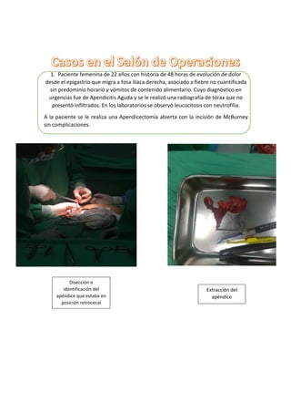1. Paciente femenina de 22 años con historia de 48 horas de evolución de dolor
desde el epigastrio que migra a fosa ilíaca derecha, asociado a fiebre no cuantificada
sin predominio horario y vómitos de contenido alimentario. Cuyo diagnóstico en
urgencias fue de Apendicitis Aguda y se le realizó una radiografía de tórax que no
presentó infiltrados. En los laboratorios se observó leucocitosis con neutrofilia.
A la paciente se le realiza una Apendicectomía abierta con la incisión de McBurney
sin complicaciones.
Disección e
identificación del
apéndice que estaba en
posición retrocecal
Extracción del
apéndice
 
