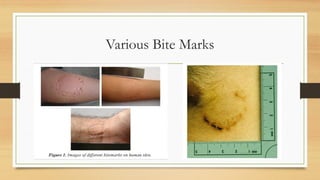 BITE MARK IN FORENSIC ODONTOLOGY , DEPARTMENT OF ORAL MEDICINE AND ...