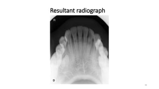 Bitewing Radiography Slide Bitewing and Occlusal radiography .pptx