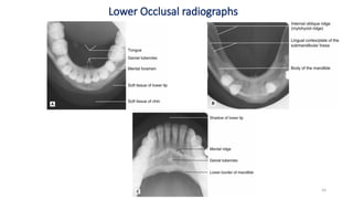Bitewing Radiography Slide Bitewing and Occlusal radiography .pptx