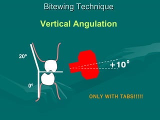 Bite-wing and technique errors lecture1 | PPT