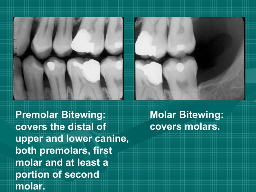 Bitewing and technique errors lecture1