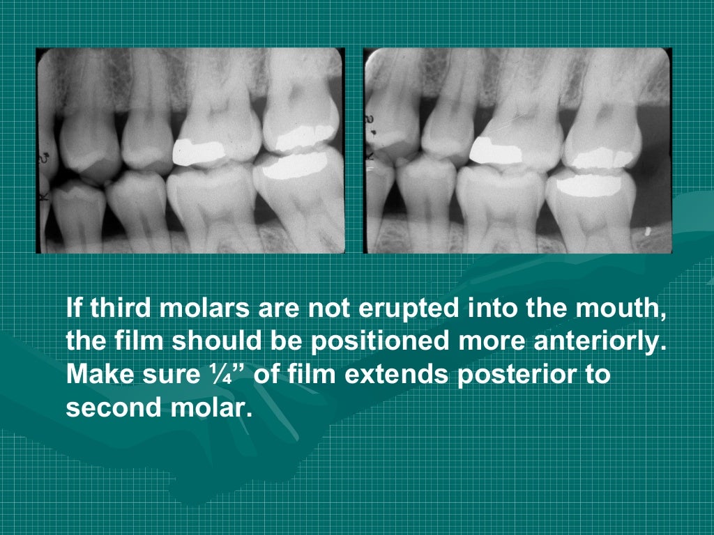 Bitewing and technique errors lecture1
