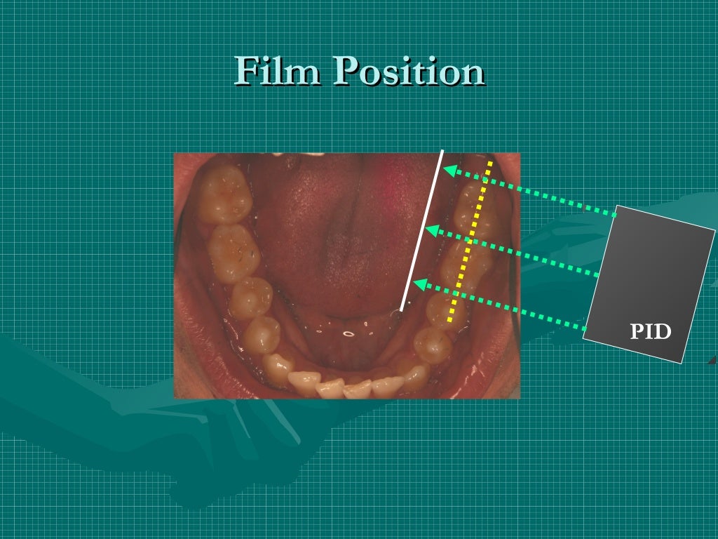 Bitewing and technique errors lecture1