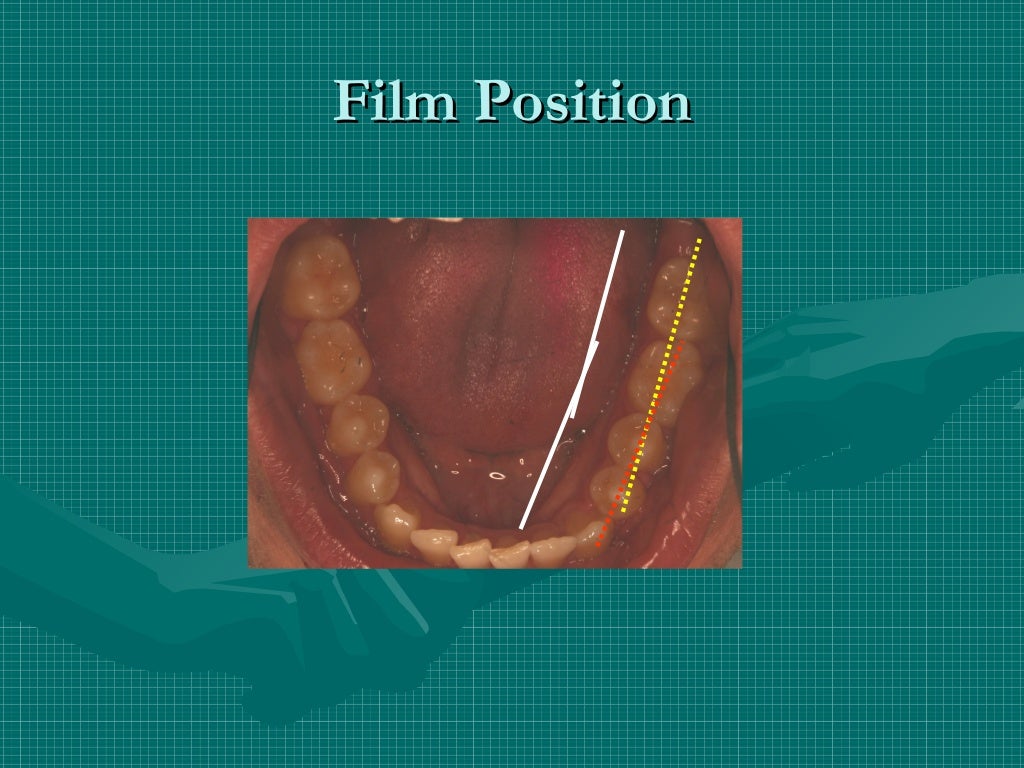 Bitewing and technique errors lecture1