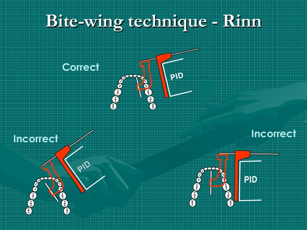 Bitewing and technique errors lecture1
