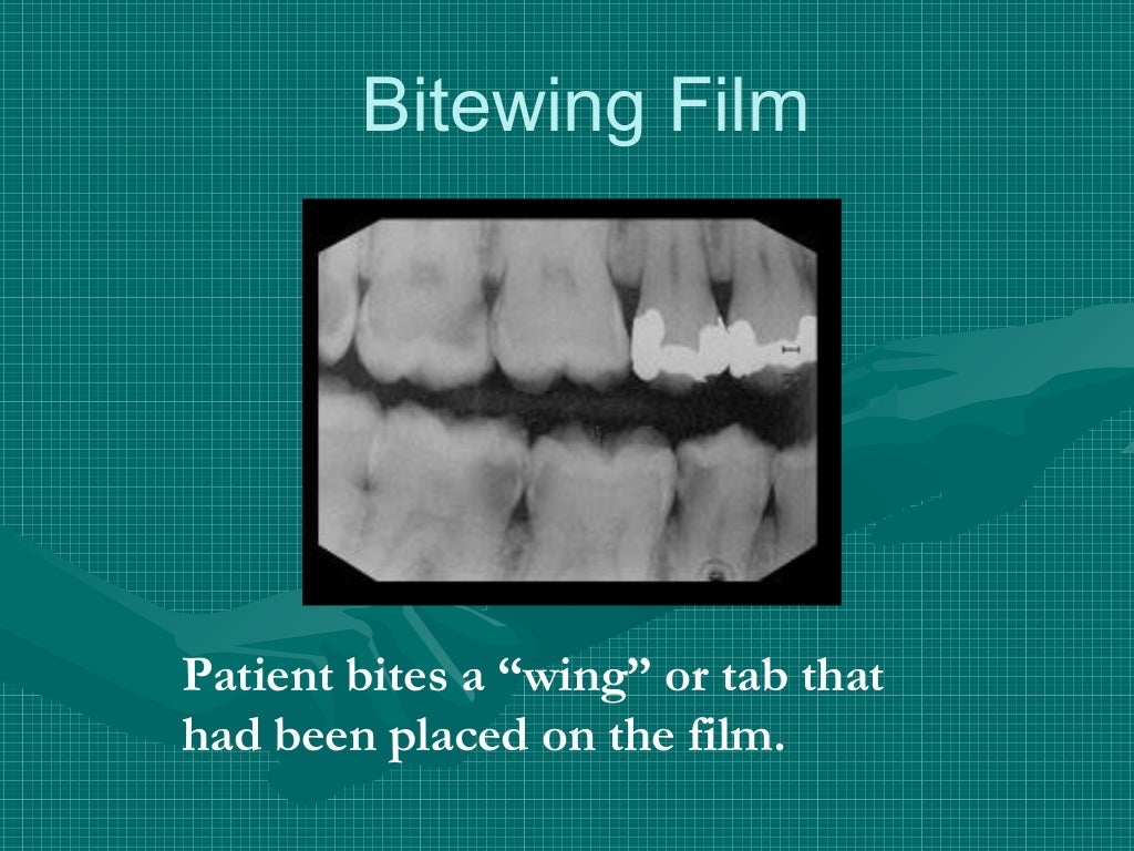 Bitewing and technique errors lecture1