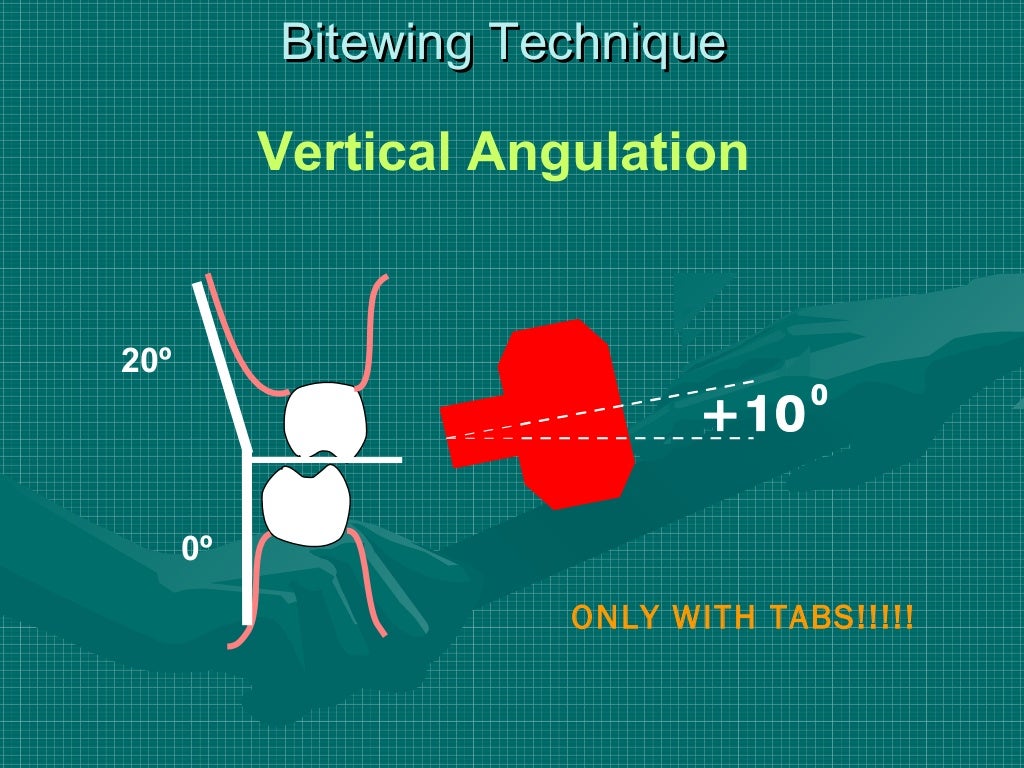 Bitewing and technique errors lecture1