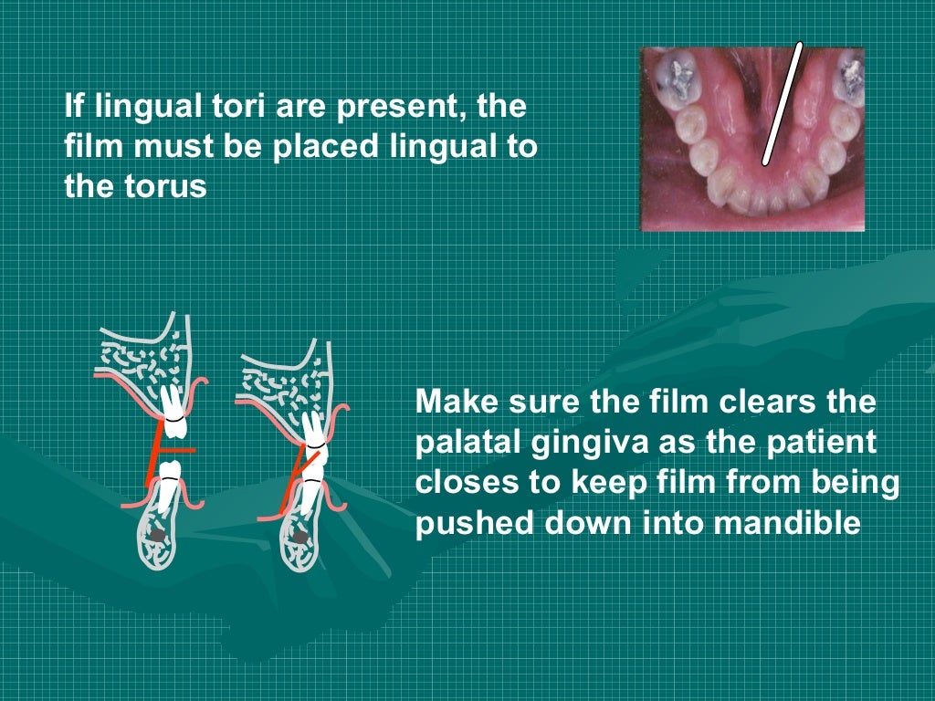 Bitewing and technique errors lecture1