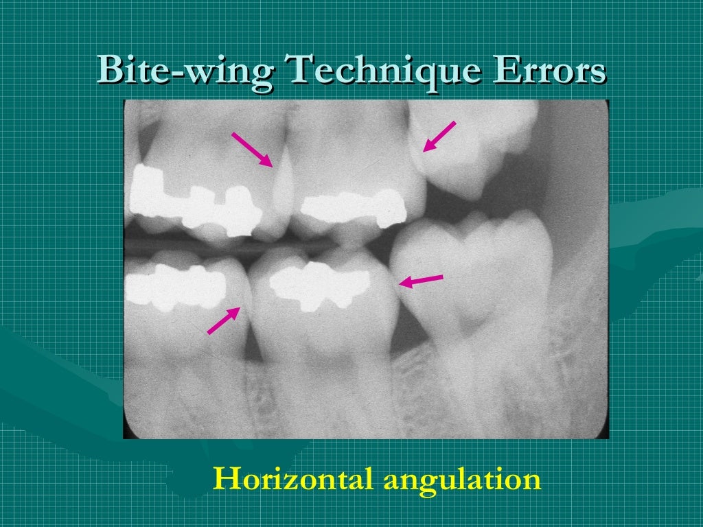 Bitewing and technique errors lecture1