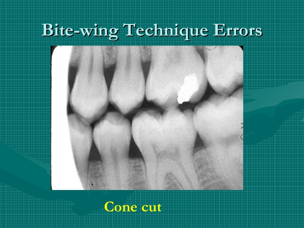 Bitewing and technique errors lecture1