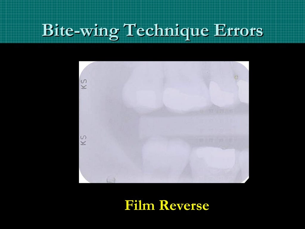 Bitewing and technique errors lecture1