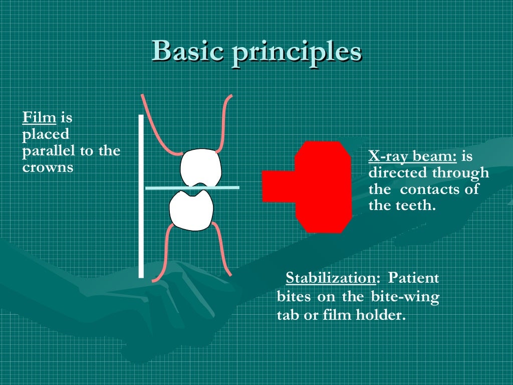 Bitewing and technique errors lecture1