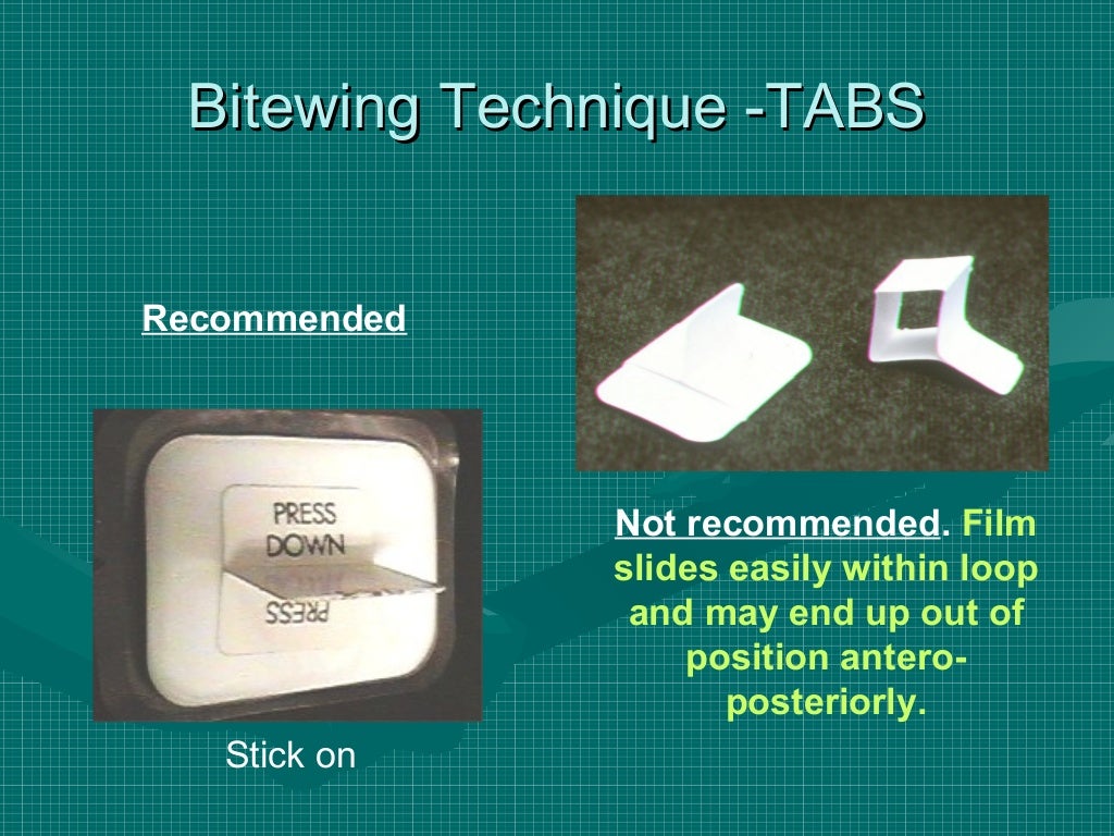 Bitewing and technique errors lecture1