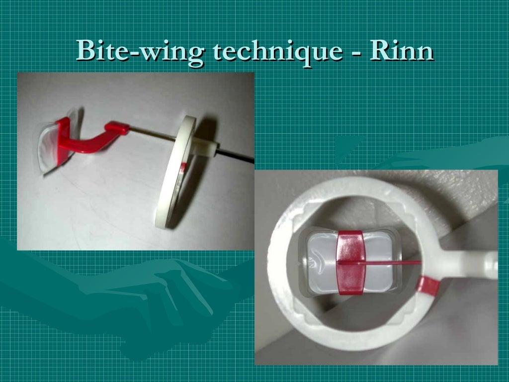 Bitewing and technique errors lecture1