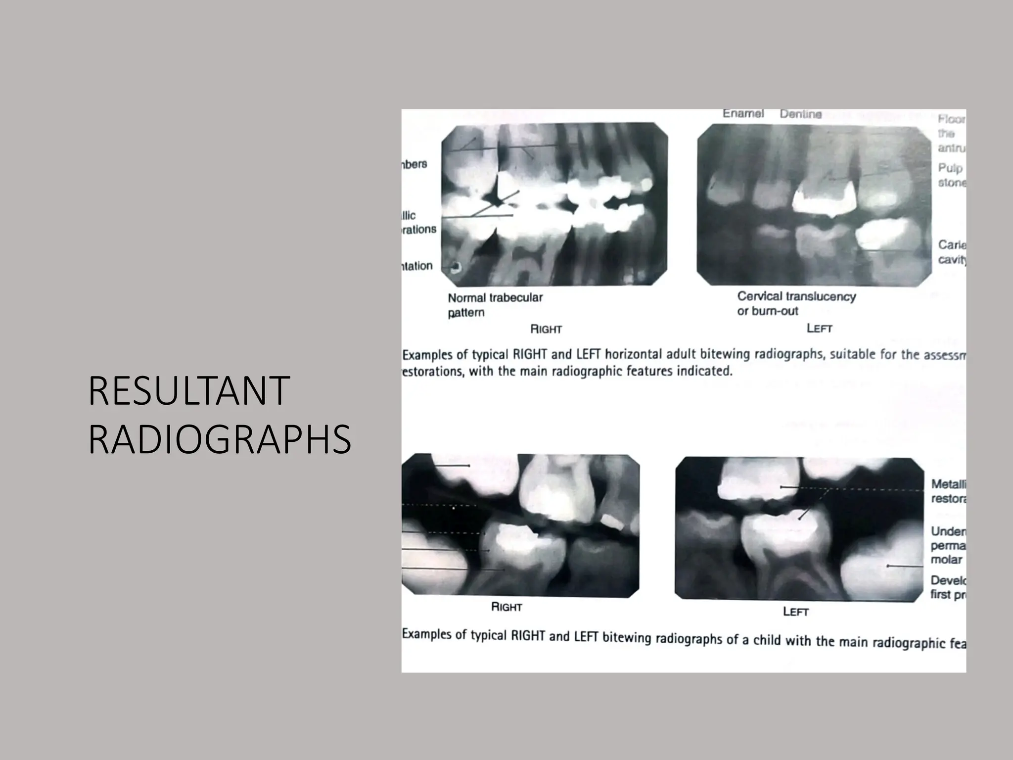 RESULTANT
RADIOGRAPHS
 