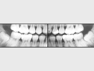 Bitewing Technique.pptx