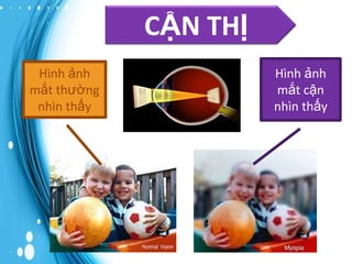 CẬN THỊ
Hình ảnh
mắt thường
nhìn thấy

Hình ảnh
mắt cận
nhìn thấy

 