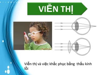 VIỄN THỊ

Viễn thị và việc khắc phục bằng thấu kính
lồi

 