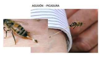 AGUIJÓN - PICADURA
AGUIJÓN - PICADURA