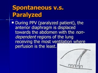 Spontaneous v.s. Paralyzed During PPV (paralyzed patient), the anterior diaphragm is displaced towards the abdomen with the  non-dependent  regions of the lung receiving the most ventilation where perfusion is the least. 